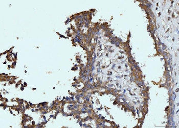IHC staining of FFPE human breast cancer tissue with GLS antibody. HIER: boil tissue sections in pH8