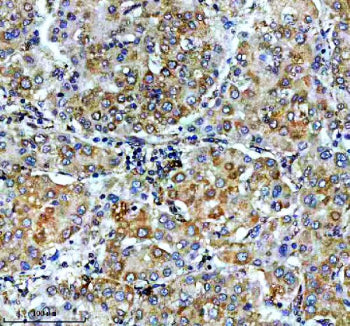 IHC staining of FFPE human liver cancer tissue with VASP antibody, HRP-secondary and DAB substrate.