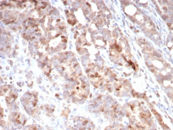 IHC staining of FFPE human colon carcinoma tissue with Survivin antibody (clone BIRC5/7775). HIER: b