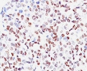 IHC: Formalin-fixed, paraffin-embedded human melanoma stained with anti-MITF antibody (clone SPM290)