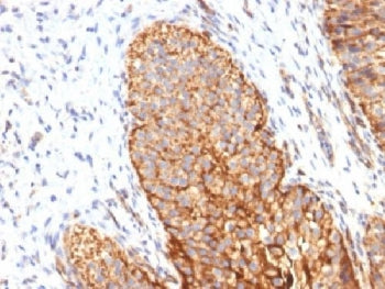 IHC testing of FFPE human bladder carcinoma with Thrombomodulin antibody (clone THBD/1591). HIER: bo