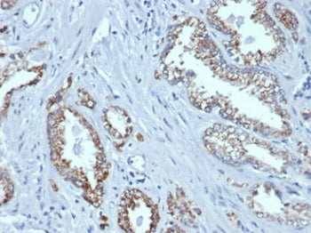 IHC staining of FFPE human prostate tissue with recombinant AMACR antibody (clone rAMACR/6369). HIER