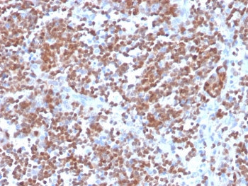 IHC staining of FFPE human mantle cell carcinoma with recombinant Cyclin D1 antibody (clone CCND1/33