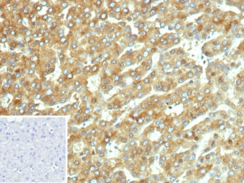 IHC staining of FFPE human hepatocellular carcinoma tissue with Cytochrome P450 2C9 antibody (clone