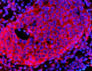Immunofluorescent staining of FFPE human breast cancer tissue with HMG CoA Reductase antibody (red)