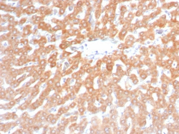 IHC staining of FFPE human hepatocellular carcinoma tissue with recombinant SDHB antibody (clone rSD