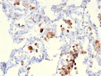 IHC staining of FFPE human lung adenocarcinoma with Napsin A antibody (clone NAPSA/3306). HIER: boil