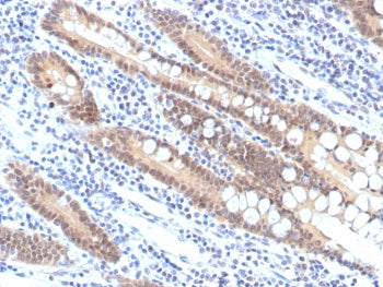 IHC staining of FFPE human pancreatic carcinoma tissue with recombinant SMAD4 antibody (clone SMAD4/