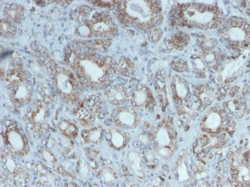 IHC staining of FFPE human breast cancer with Purified RET antibody (clone RET/2975). HIER: boil tis