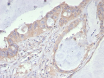 IHC staining of FFPE human colon cancer tissue with PDGFRA antibody (clone PDGFRA/7407). HIER: boil