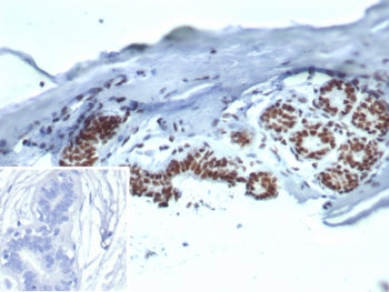 IHC staining of FFPE human breast carcinoma tissue with Heat shock 70 kDa protein 1B antibody (clone