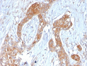 IHC staining of FFPE human breast carcinoma with A20 antibody (clone TNFAIP3/2813). HIER: boil tissu
