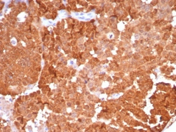 IHC staining of FFPE human ovarian carcinoma tissue with P16INK4a antibody (clone CDKN2A/8223R). HIE