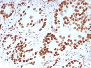IHC staining of FFPE human prostate carcinoma tissue with Androgen Receptor antibody (clone DHTR/869