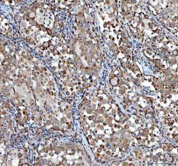 IHC staining of FFPE human lung cancer tissue with TCP1 alpha antibody. HIER: boil tissue sections i