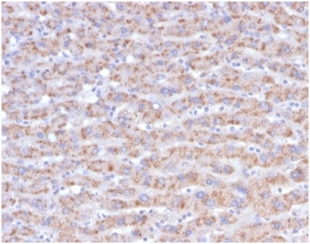 IHC staining of FFPE human liver carcinoma in colon tissue with CD40L antibody (clone CD40LG/4675) a