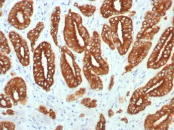 IHC staining of FFPE human prostate carcinoma tissue with Type I Cytokeratin antibody (clone KRTL/77