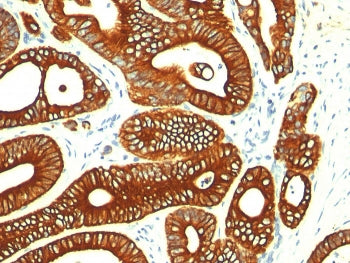 IHC: Formalin-fixed, paraffin-embedded human colon carcinoma stained with Cytokeratin 18 antibody (c