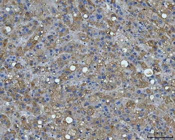 IHC staining of FFPE human liver cancer tissue with BI-1 antibody. HIER: boil tissue sections in pH8