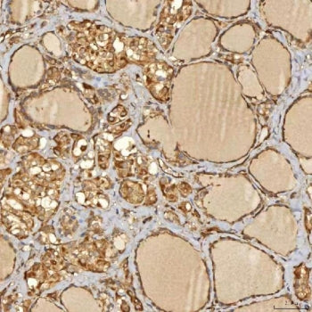 IHC staining of FFPE human thyroid papillary carcinoma tissue with Sorting nexin 4 antibody. HIER: b