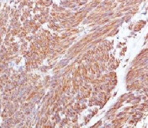 IHC testing of FFPE human gastrointestinal stromal tumor (GIST) and CD117 antibody (clone CLDA117).