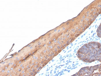 IHC staining of FFPE human colon carcinoma with recombinant Type I Cytokeratin antibody (clone KRTH/