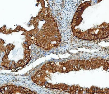 IHC staining of FFPE human ovarian cancer tissue with Inosine-5'-monophosphate dehydrogenase 2 antib