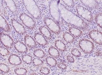IHC staining of FFPE human colon carcinoma tissue with recombinant MLH1 antibody (clone MLH1/6284R).