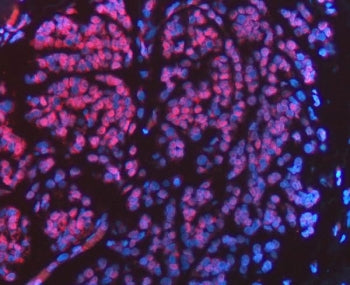 Immunofluorescent staining of FFPE human breast cancer tissue with FIP1L1 antibody (red) and DAPI nu