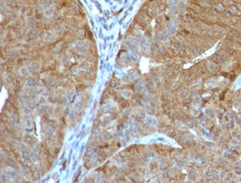 IHC testing of FFPE human prostate cancer with AKR1B1 antibody (clone ADRD1-1). Required HIER: boil
