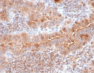 IHC staining of FFPE human thyroid with Calcitonin antibody (clone CALCA/3310). HIER: boil tissue se