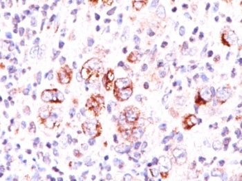 IHC: Formalin-fixed, paraffin-embedded human Hodgkin's lymphoma stained with Bcl-x antibody (2H12).