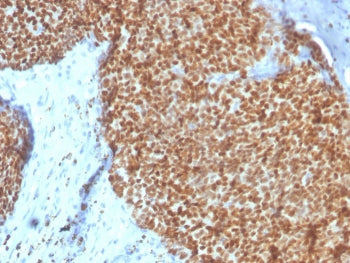 IHC staining of FFPE human breast with Estrogen Receptor alpha antibody (clone ESR1/4008). HIER: boi