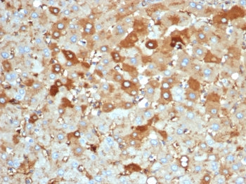 IHC staining of FFPE human liver carcinoma in colon tissue with Albumin antibody (clone rALB/6414).