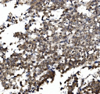 IHC staining of FFPE human lung cancer with TORC1/CRTC1 antibody. HIER: boil tissue sections in pH8