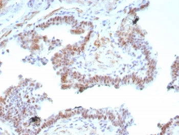 IHC staining of FFPE human prostate carcinoma tissue with recombinant Androgen Receptor V7 antibody