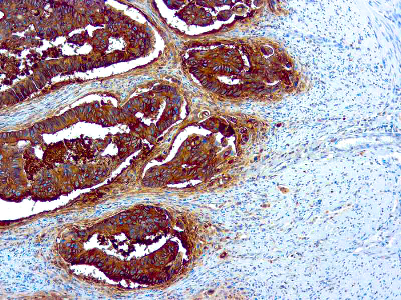 Carcinoembryonic Antigen (CEA)