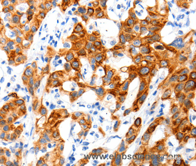 Immunohistochemistry of paraffin-embedded Human lung cancer tissue using SLC2A11 Polyclonal Antibody at dilution 1:140