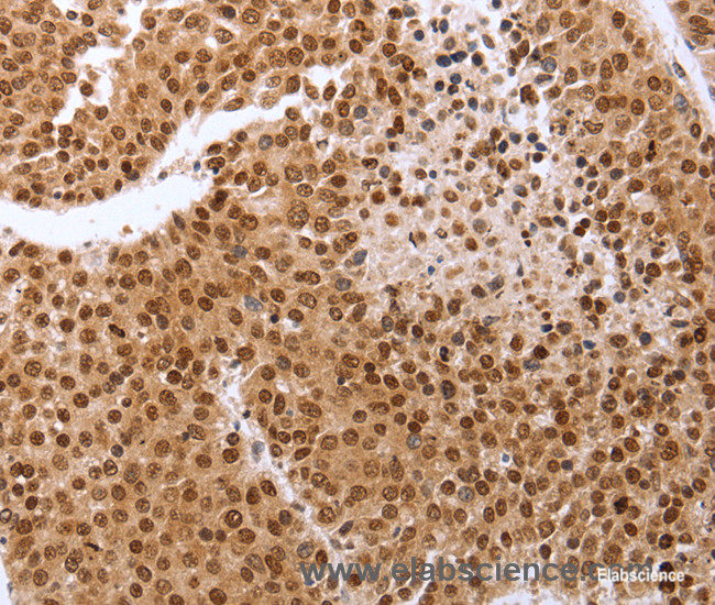 Immunohistochemistry of paraffin-embedded Human breast cancer tissue using PTTG1 Polyclonal Antibody at dilution 1:60