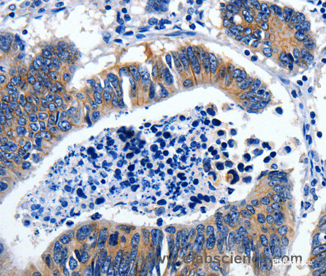 Immunohistochemistry of paraffin-embedded Human colon cancer tissue using GAD2 Polyclonal Antibody at dilution 1:30