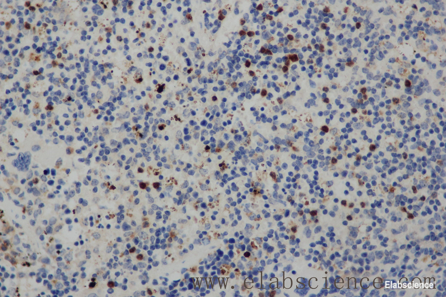 Immunohistochemistry of paraffin-embedded Human cervical cancer tissue using CD68 Polyclonal Antibody at dilution 1:30