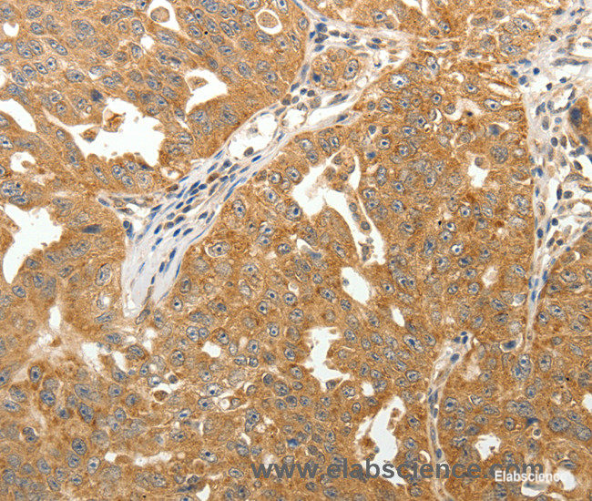 Immunohistochemistry of paraffin-embedded Human ovarian cancer tissue using MAP1B Polyclonal Antibody at dilution 1:40