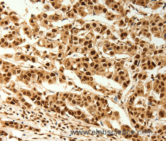 Immunohistochemistry of paraffin-embedded Human cervical cancer tissue using C12orf5 Polyclonal Antibody at dilution 1:80