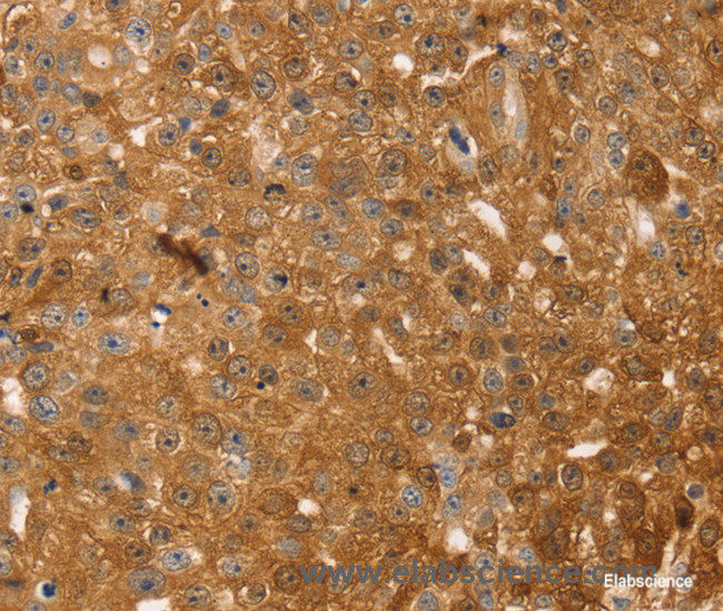 Immunohistochemistry of paraffin-embedded Human breast cancer tissue using TMSB10 Polyclonal Antibody at dilution 1:35