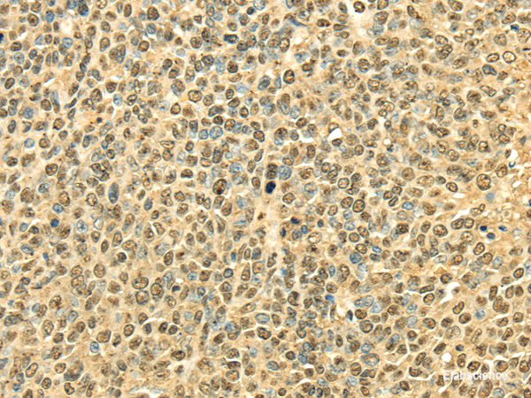 Immunohistochemistry of paraffin-embedded Human ovarian cancer using RPA2 Polyclonal Antibody at dilution of 1/40
