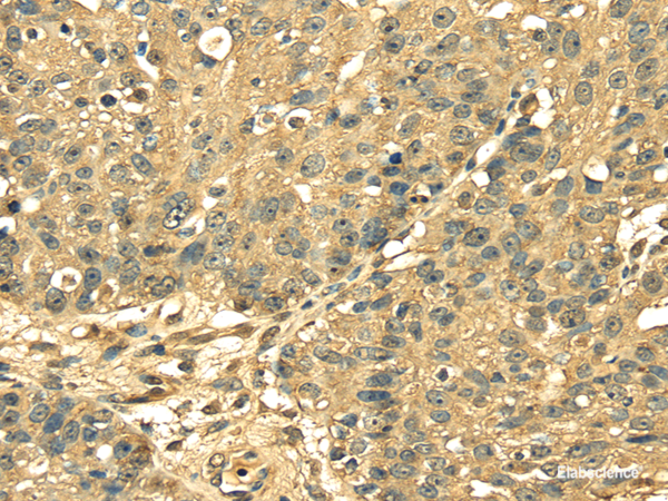 Immunohistochemistry of paraffin-embedded Human breast cancer using RPS3 Polyclonal Antibody at dilution of 1/25