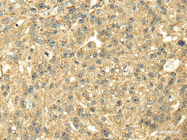 Immunohistochemistry of paraffin-embedded Human breast cancer using SDHA Polyclonal Antibody at dilution of 1/40