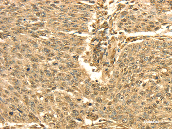 Immunohistochemistry of paraffin-embedded Human lung cancer using SEPT2 Polyclonal Antibody at dilution of 1/30