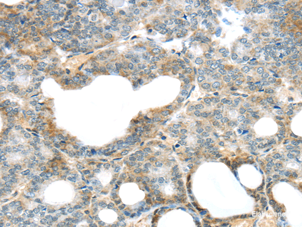 Immunohistochemistry of paraffin-embedded Human thyroid cancer using SERPINB11 Polyclonal Antibody at dilution of 1/20