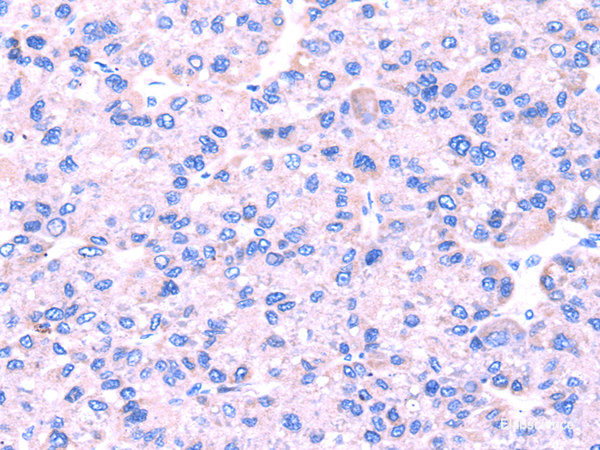 Immunohistochemistry of paraffin-embedded Human liver cancer using SRPK1 Polyclonal Antibody at dilution of 1/45